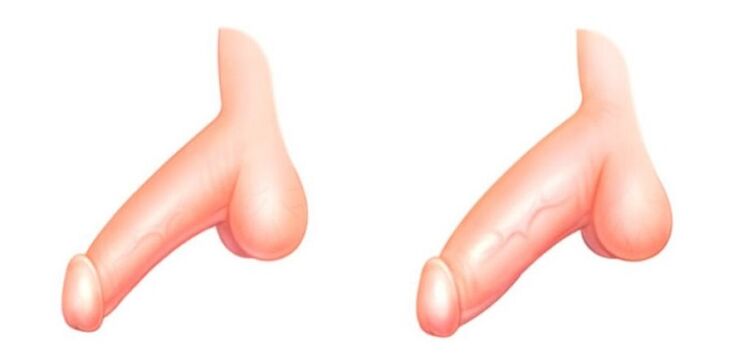 pênis antes e depois do aumento